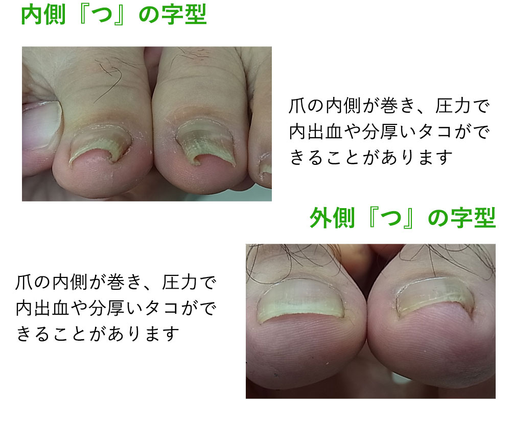 楽天市場】☆痛みにさようなら！☆毎日快適！巻き爪リフト まきづめ